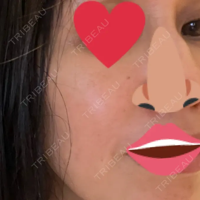 イオン導入 / 毛穴洗浄（ハイドラフェイシャルなど） GRACIA clinic 【グラシアクリニック】 BEFORE メイン用