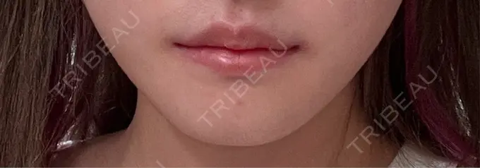 ヒアルロン酸注入（唇） / その他（口元） R Beauty CLINIC 銀座院 BEFORE メイン用