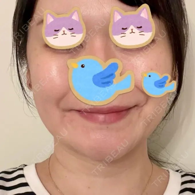 糸リフト / クマ治療 / 脂肪吸引（顔） / 脂肪注入（目の下） / ヒアルロン酸注入（涙袋） / ヒアルロン酸注入（唇） 東京シンデレラ美容外科 池袋院 BEFORE メイン用