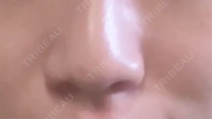 ヒアルロン酸注入（鼻） NARU Beauty Clinic 【ナルクリ】 BEFORE メイン用