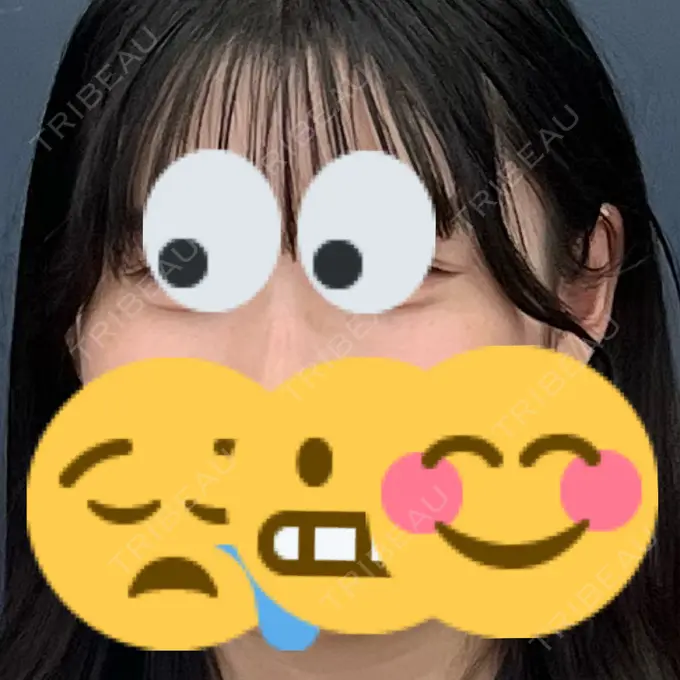 シミ取りレーザー S-Laboクリニック 渋谷院 BEFORE メイン用