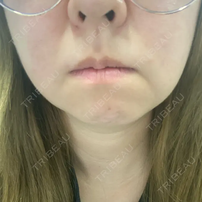 美容点滴・美容注射（ダイエット） / ハイフ（顔） S-Laboクリニック 渋谷院 BEFORE メイン用