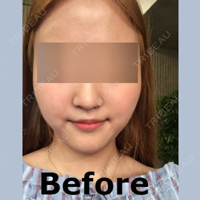 脂肪溶解注射（顔） id美容クリニック 銀座院 BEFORE メイン用