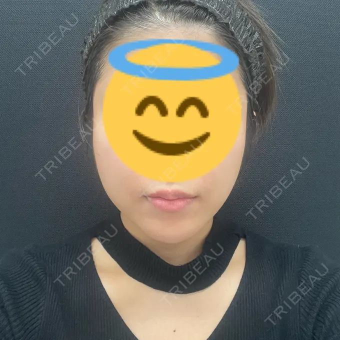 糸リフト 東京シンデレラ美容外科 池袋院 BEFORE メイン用