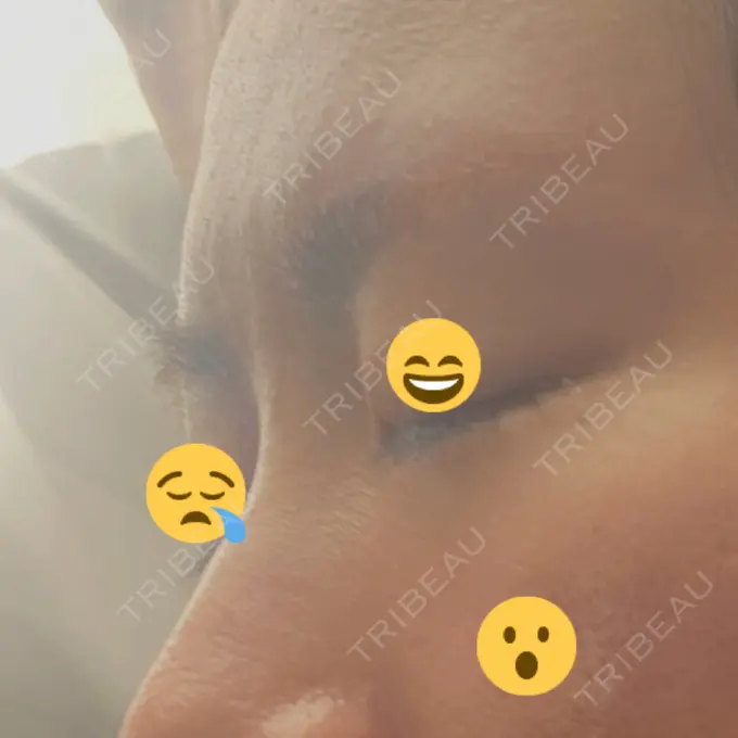 ボトックス（眉間） TCB東京中央美容外科 千葉駅前院 BEFORE メイン用