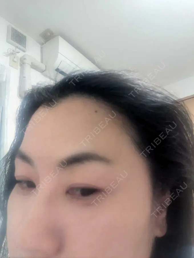 ボトックス（あご） / ボトックス（眉間） / ボトックス（額） TCB東京中央美容外科 松山院 BEFORE メイン用