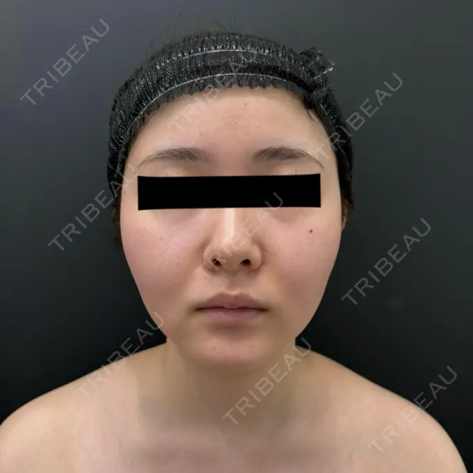 糸リフト / バッカルファット除去 / 脂肪吸引（顔） BLINC CLINIC （ブリンク クリニック） BEFORE メイン用