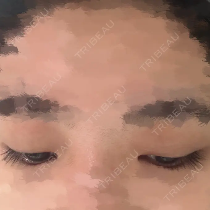 アートメイク（アイライン） M'sクリニック【エムズクリニック】 BEFORE メイン用