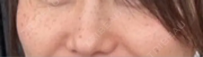 イオン導入 / ルメッカ ルラ美容クリニック 札幌本院 BEFORE メイン用