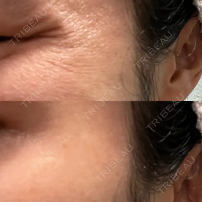 ボトックス（目尻） 湘南美容クリニック 立川院 BEFORE メイン用