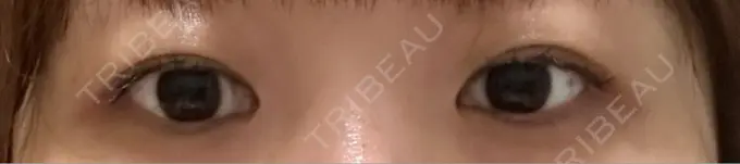 二重埋没 / 自然癒着法 Brandnew Beauty Clinic BEFORE メイン用