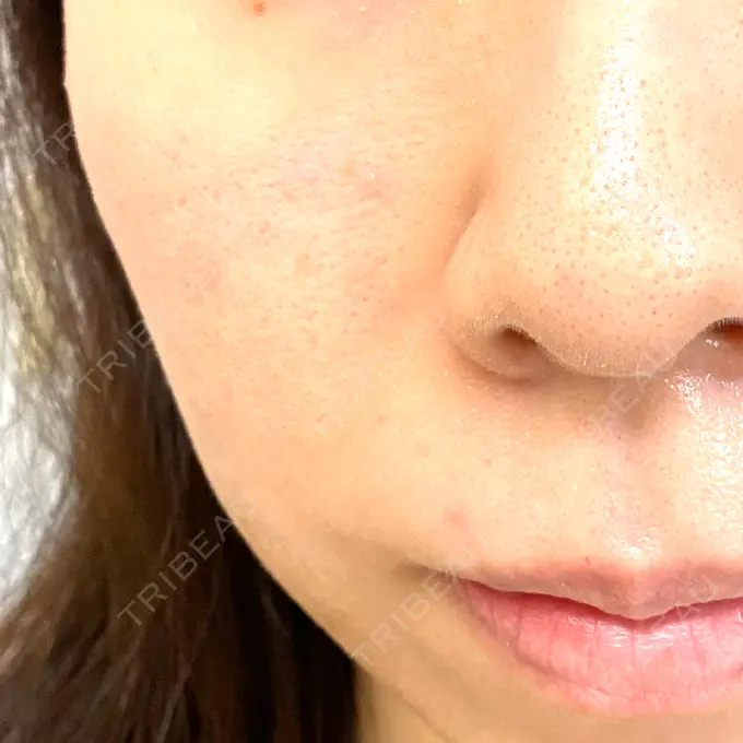 医療脱毛（顔） NI MEDICAL CLINIC BEFORE メイン用