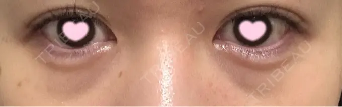 クマ治療 / 肌ヒアルロン酸注入（たるみ・シワ改善） / ヒアルロン酸注入（目の下） 東京シンデレラ美容外科 池袋院 BEFORE メイン用