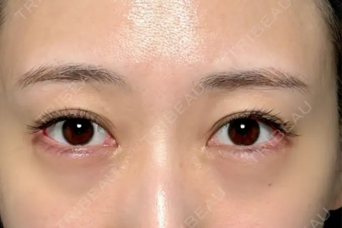 クマ治療 / 下まぶたの脂肪取り / 脂肪注入（目の下） セオリークリニック BEFORE メイン用