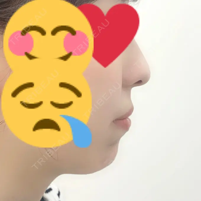 ボトックス（あご） / ヒアルロン酸注入（あご） / ボトックス（エラ・小顔） TCB東京中央美容外科 新宿東口院 BEFORE メイン用