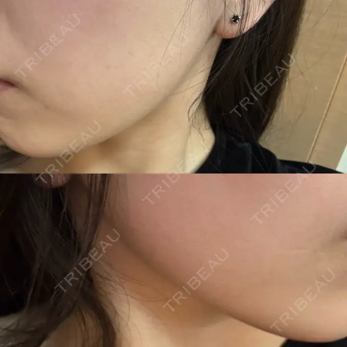 ハイフ（顔） しんゆり美容健康クリニック BEFORE メイン用