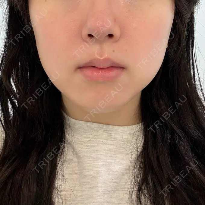 ハイフ（顔） しんゆり美容健康クリニック BEFORE メイン用