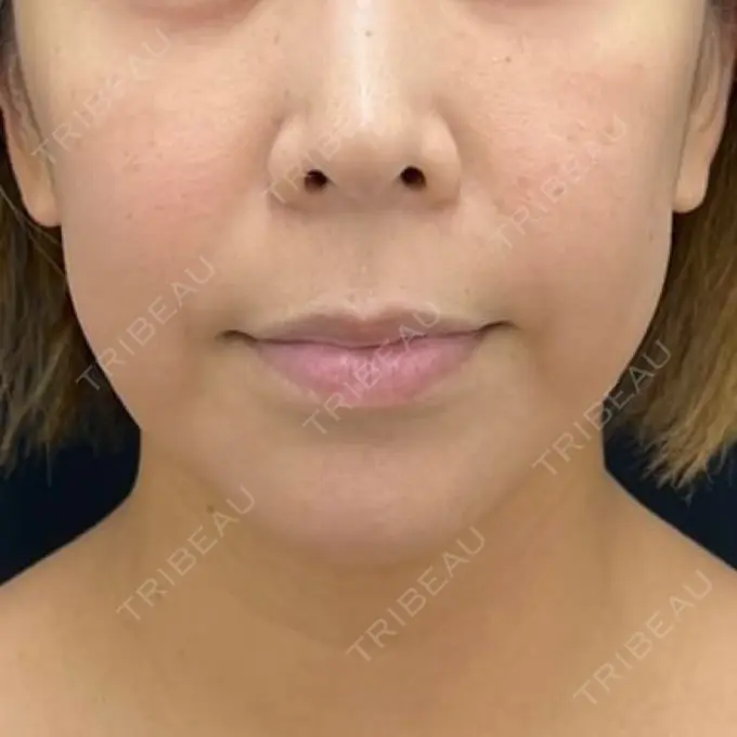 糸リフト / 脂肪吸引注射（顔） 湘南美容クリニック 吉祥寺院 BEFORE メイン用