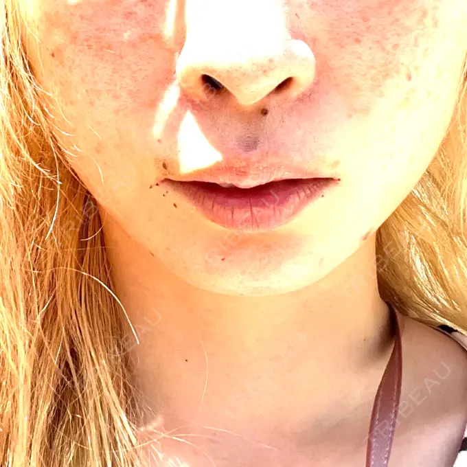 ハイフ（顔） AZ BEAUTY CLINIC BEFORE メイン用