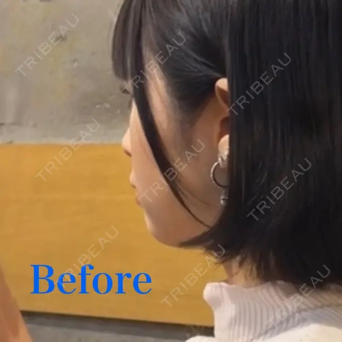 糸リフト / あごプロテーゼ / 脂肪吸引（顔） / ボトックス（エラ・小顔） WOM CLINIC GINZA （ワム クリニック ギンザ） BEFORE メイン用