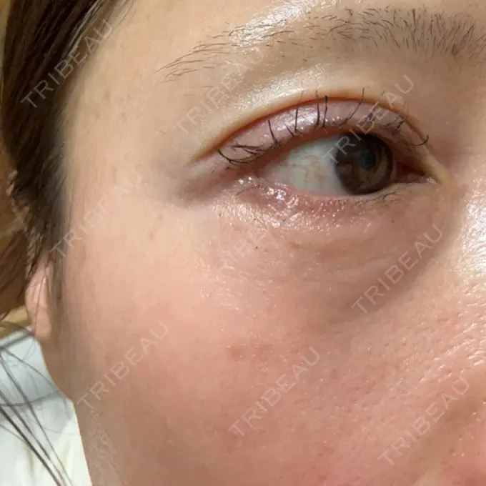 ボトックス（エラ・小顔） / 肌育注射（ジュベルックなど） / ピコスポット APスキンクリニック銀座 BEFORE メイン用