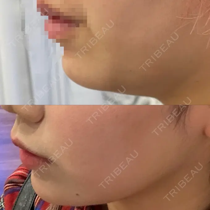 糸リフト / あごプロテーゼ / 脂肪吸引（顔） / メーラーファット除去 WOM CLINIC GINZA （ワム クリニック ギンザ） BEFORE メイン用