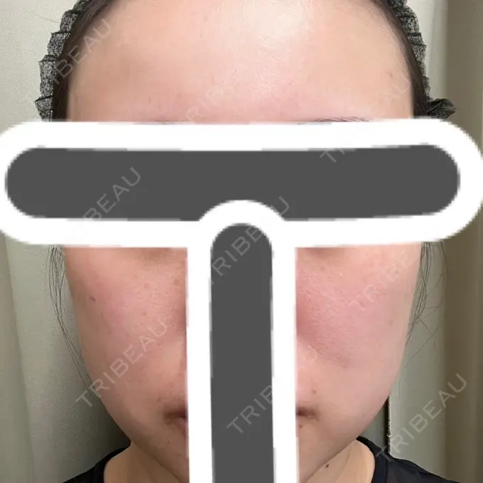 その他（肌） 湘南美容クリニック 名古屋駅本院 BEFORE メイン用