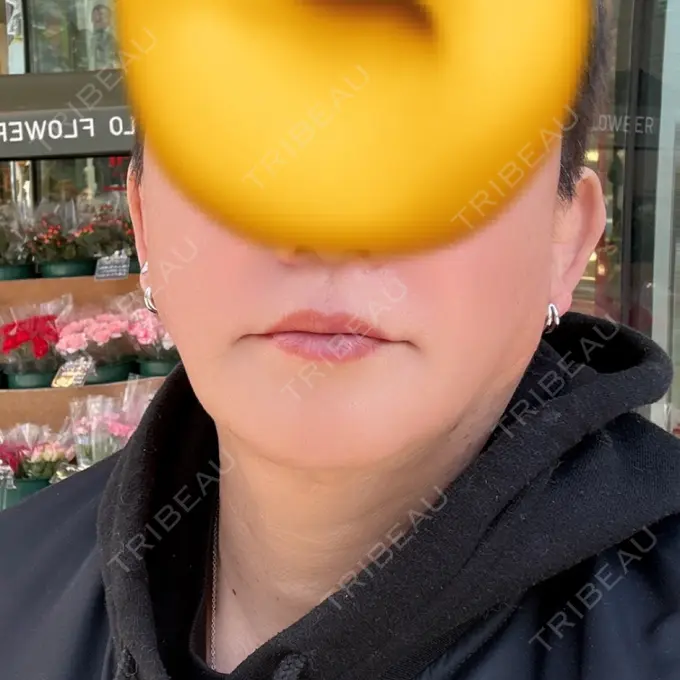 シミ取りレーザー / 美白レーザー / エレクトロポレーション / ピコレーザートーニング（美白・肝斑） / フラクショナルレーザー（毛穴・ニキビ跡） / YAGレーザー / レーザートーニング（美白・肝斑） / 赤み除去レーザー / ピコフラクショナルレーザー（毛穴・ニキビ跡） AI Beauty Clinic （エーアイ美容クリニック） BEFORE メイン用