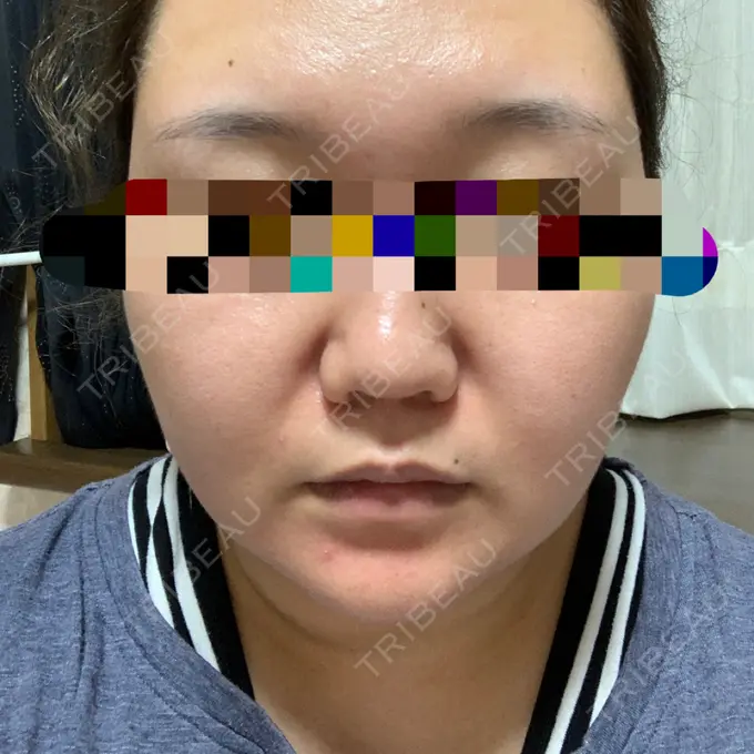 その他（目元） THE CLINIC（ザ・クリニック） 福岡院 BEFORE メイン用