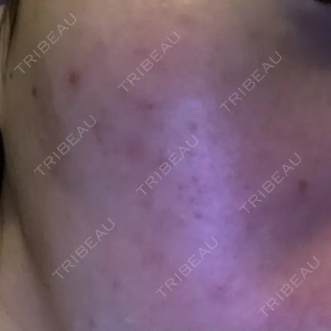 ピーリング（ニキビ・毛穴） 大美会クリニック 梅田院 BEFORE メイン用