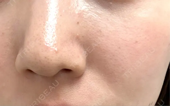 医療脱毛（顔） / 医療脱毛（ワキ） 神戸元町通クリニック BEFORE メイン用