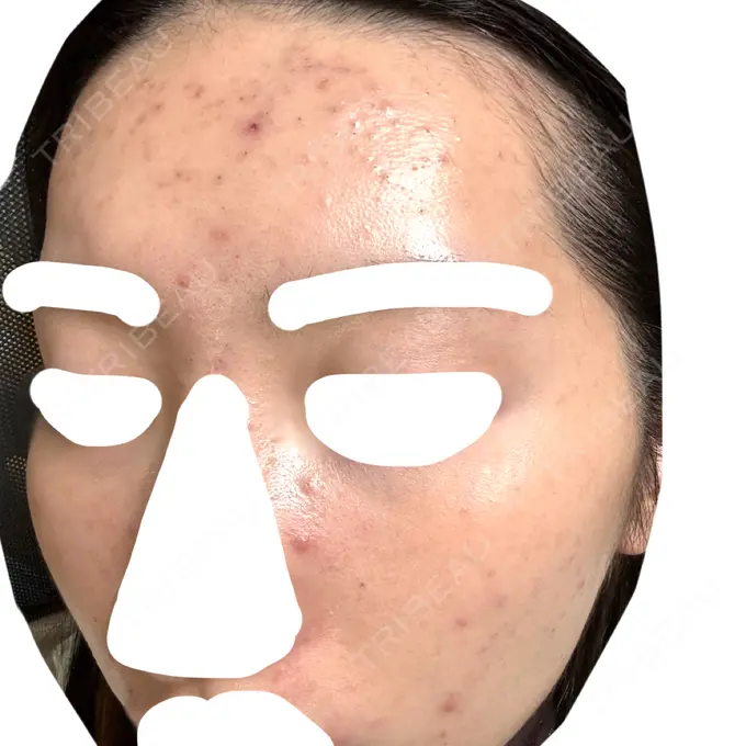 ヴェルヴェットスキン / アグネス 日本ウェルネス再生クリニック BEFORE メイン用