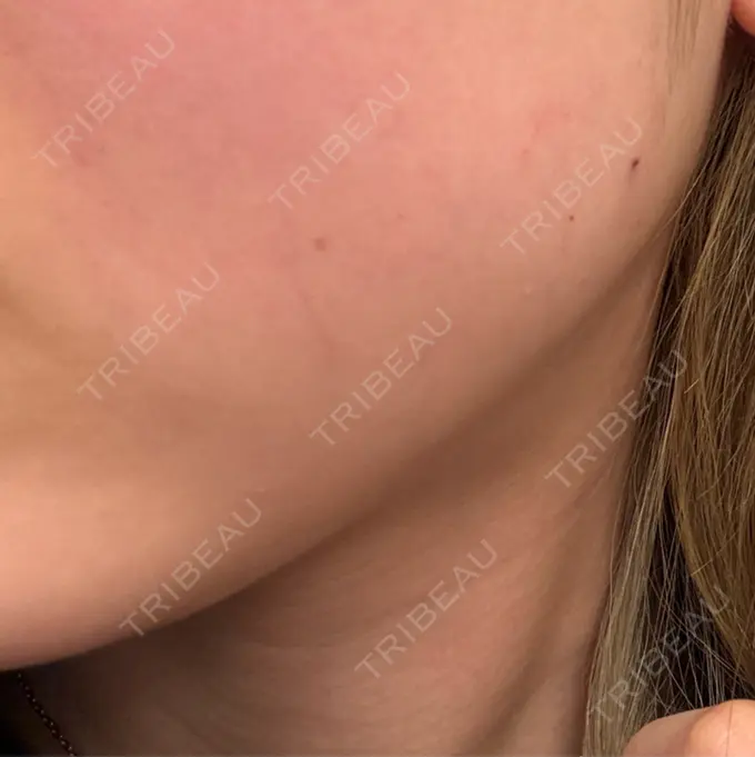 ボトックス（エラ・小顔） / ボトックス（ふくらはぎ） BiBiクリニック BEFORE メイン用