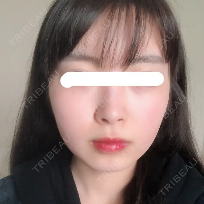 骨削り（頬） ボンディ美容整形外科（旧リオン整形外科） BEFORE メイン用