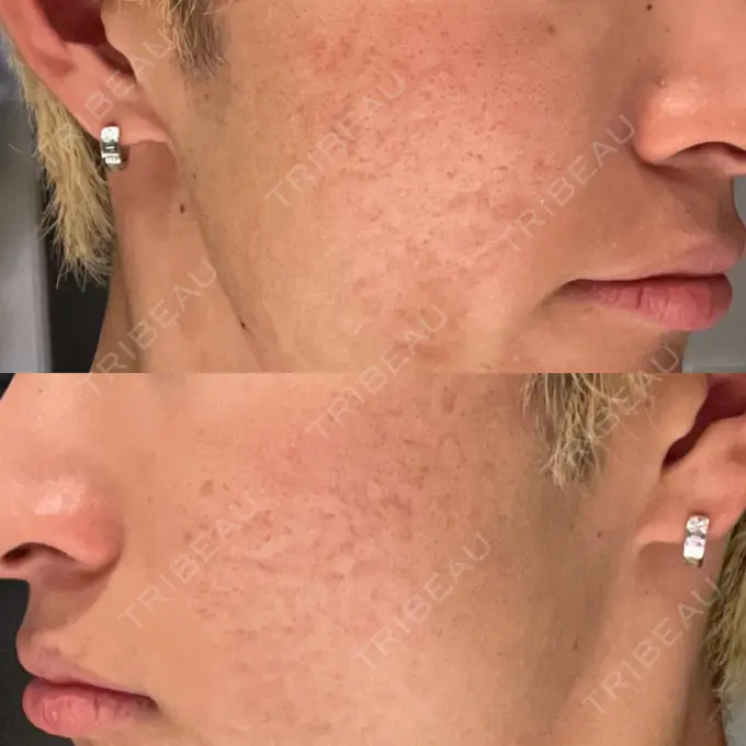 ニードルRF（ポテンツァなど） Re：HADA CLINIC 銀座 BEFORE メイン用