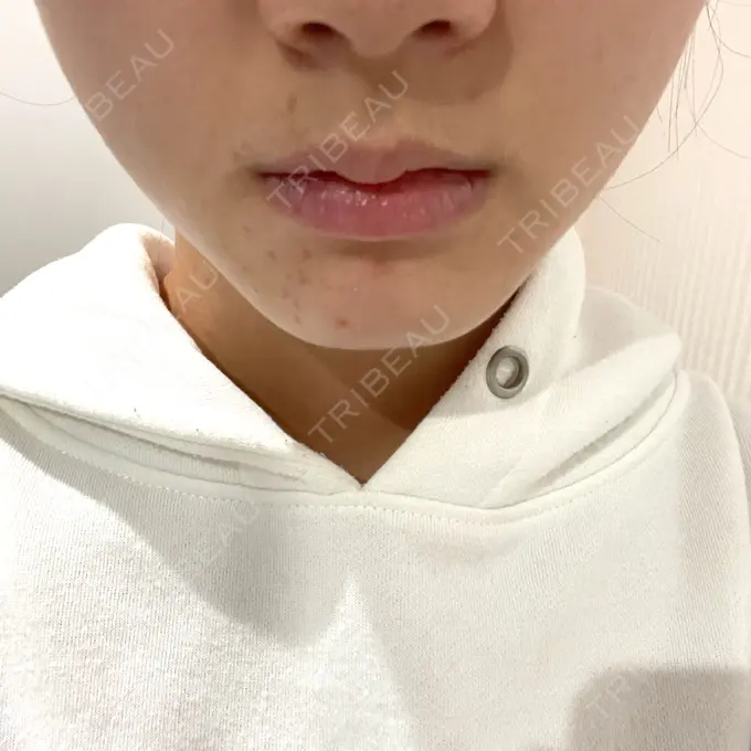 ボトックス（エラ・小顔） TCB東京中央美容外科 柏院 BEFORE メイン用