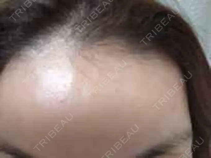 その他（肌） / リジュラン 湘南美容クリニック 仙台院 BEFORE メイン用