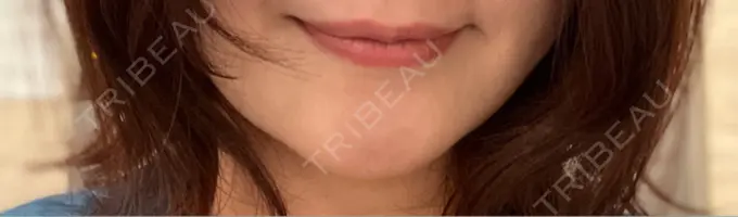 ボトックス（あご） 東京美容医療クリニック 池袋院 BEFORE メイン用