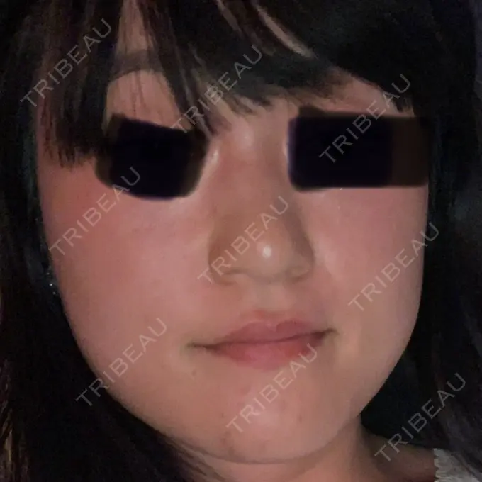 ボトックス（あご） / ボトックス（眉間） / イオン導入 / ピーリング（ハリ・ツヤ） / ルメッカ ルラ美容クリニック 仙台院 / ルラスキンクリニック 仙台院 BEFORE メイン用