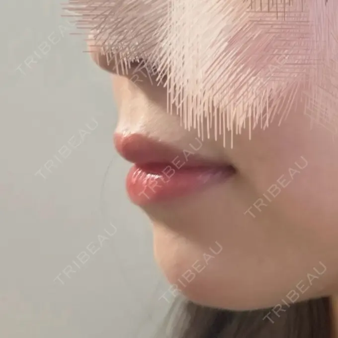 ヒアルロン酸注入（あご） 豊洲内科・糖尿病 / 形成・美容外科クリニック BEFORE メイン用