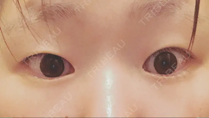 二重埋没 湘南美容クリニック 長野院 BEFORE メイン用