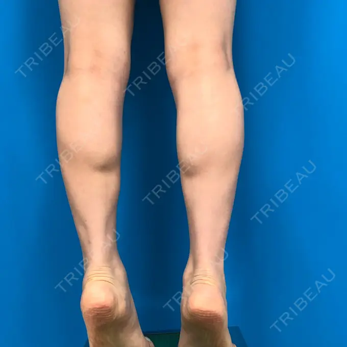 ボトックス（ふくらはぎ） ガーデンクリニック 名古屋院 BEFORE メイン用