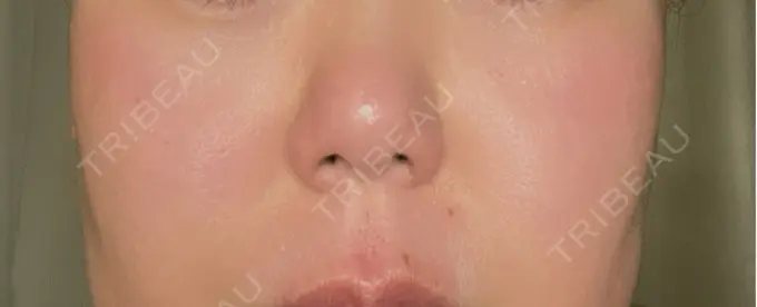 ポテンツァ 渋谷美容外科クリニック 渋谷院 BEFORE メイン用