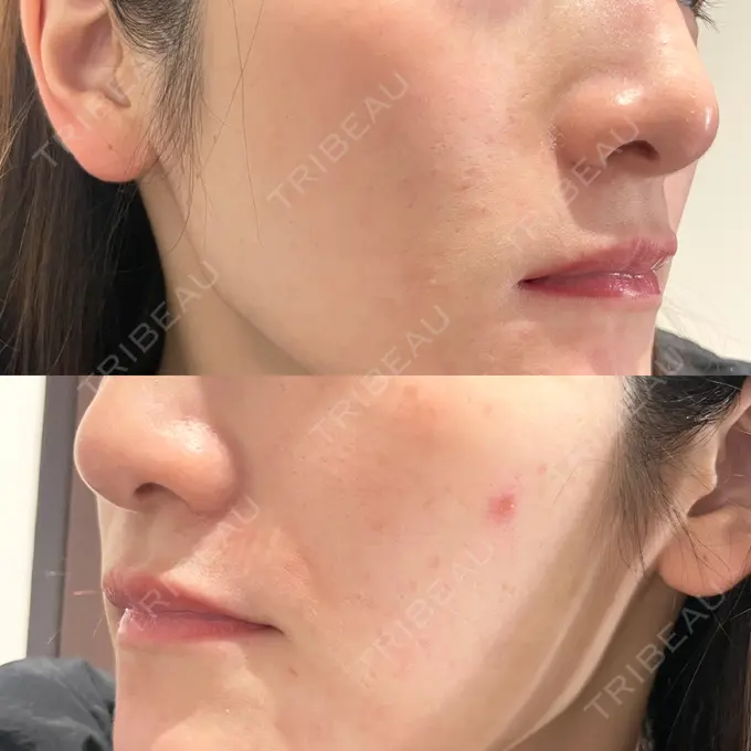 ニードルRF（ポテンツァなど） Re：HADA CLINIC 銀座 BEFORE メイン用