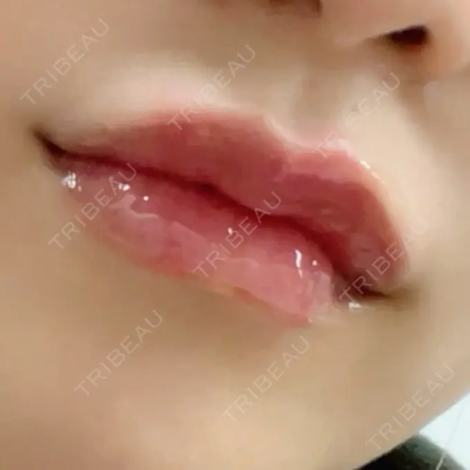 ヒアルロン酸注入（唇） ルラ美容クリニック 新宿院 BEFORE メイン用