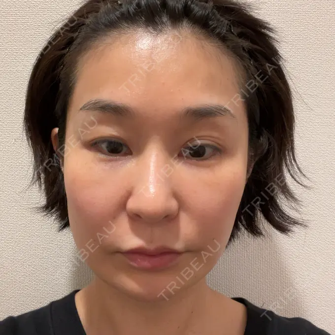 ボトックス（眉間） / ボトックス（目尻） 湘南美容クリニック 品川院 BEFORE メイン用