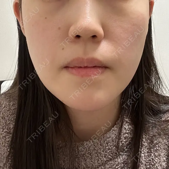 糸リフト / ヒアルロン酸注入（あご） L‘amour clinic Tokyo【ラムールクリニック東京】 BEFORE メイン用