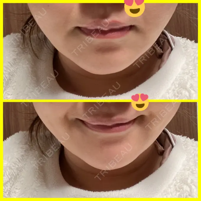 ボトックス（口角） / ボトックス（額） 東京美容医療クリニック 池袋院 BEFORE メイン用