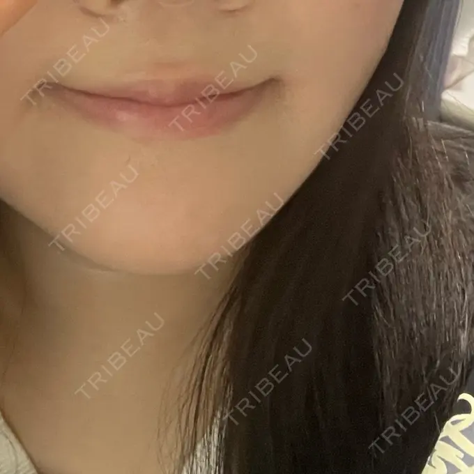 ボトックス（エラ・小顔） 筋肉・美容クリニック BEFORE メイン用