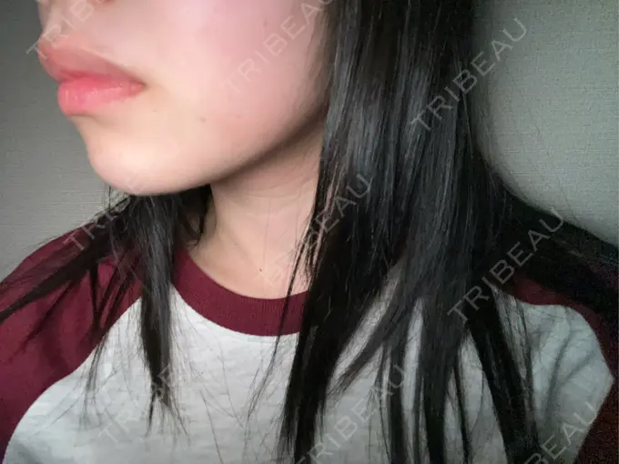 RF（高周波）たるみ治療 / その他（輪郭） 大美会クリニック 神戸院 BEFORE メイン用